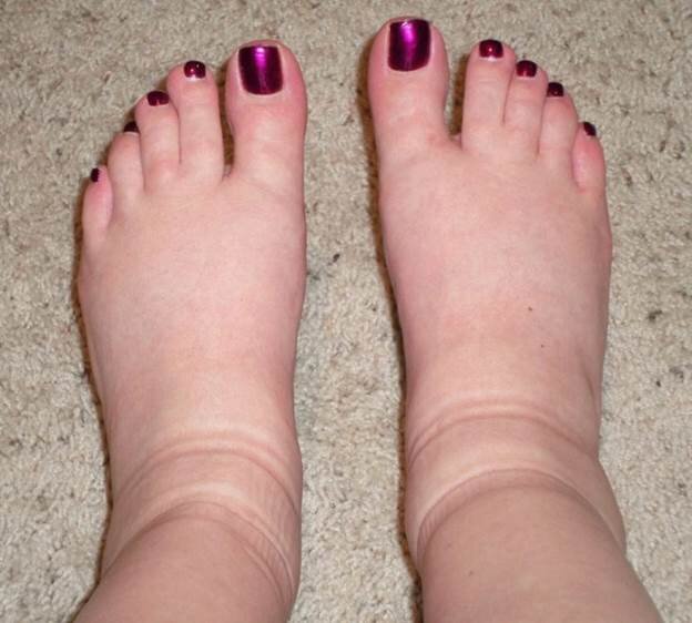 Отеки ног — причины почему отекают ноги