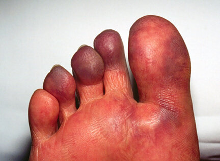 Синдром синего пальца