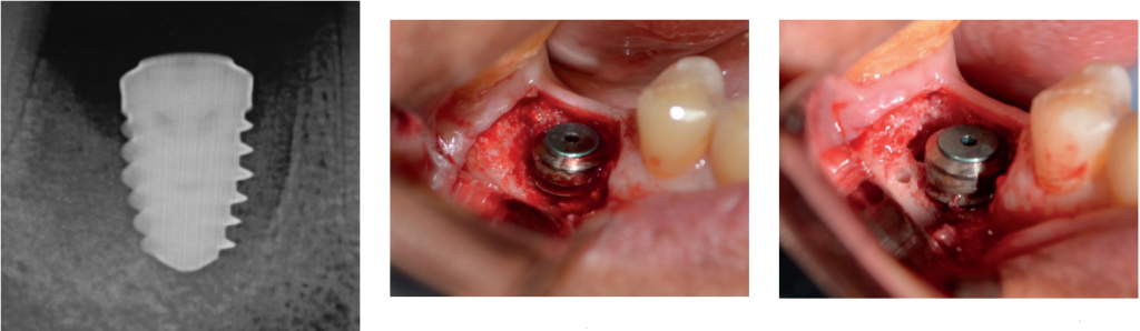 Рисунок 2 (слева): Рентгенограмма через полтора месяца после операции; Рисунок 3 (в центре): Отражение, сохраняющее сосочки; Рисунок 4 (справа): Полное отражение с дегрануляцией кости