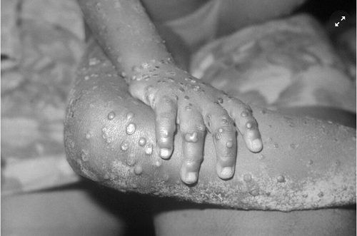 CDC's Public Health Image Library/Wikimedia Commons