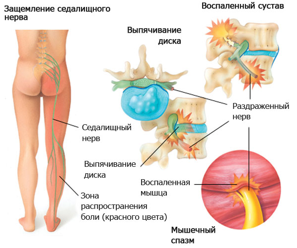 Ишиас-защемление межпозвоночной грыжей седалищного нерва  и боль в ноге.