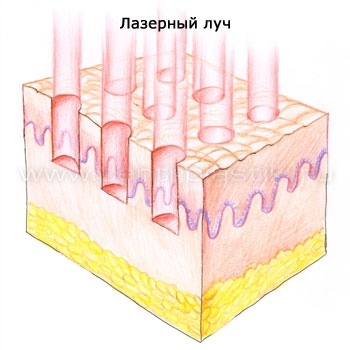 Схематично микролучи лазерного излучения (фракции). 