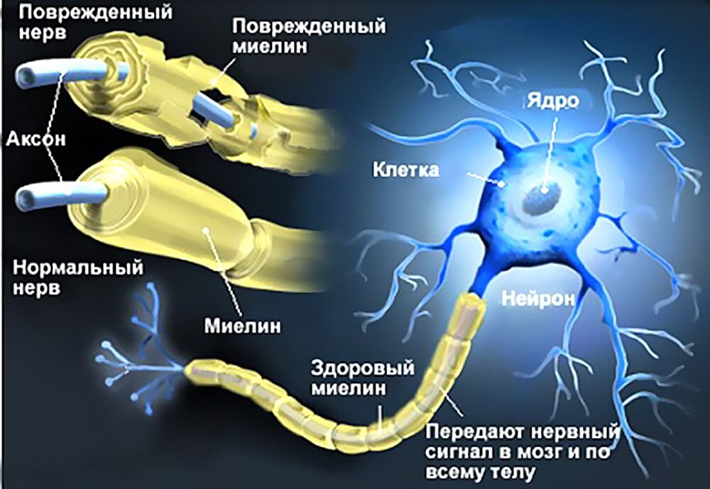 Нейрон Аксон миелиновая оболочка. Рассеянный склероз миелиновая оболочка. Демиелинизация нервных волокон. Повреждение миелиновой оболочки нерва.