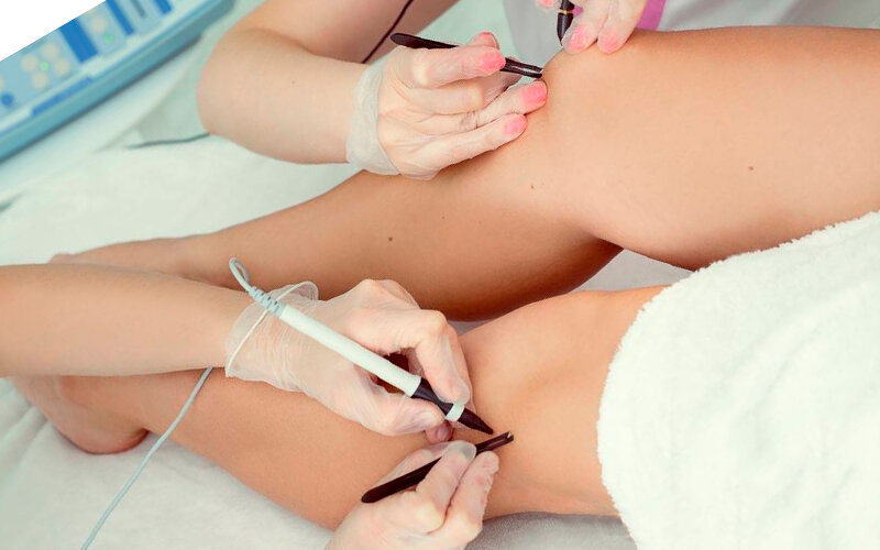 Электроэпиляция - современный метод удаления волосков