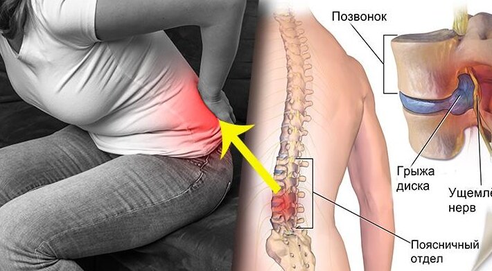 Люмбаго (прострел в пояснице) – причины и симптомы, методы лечения