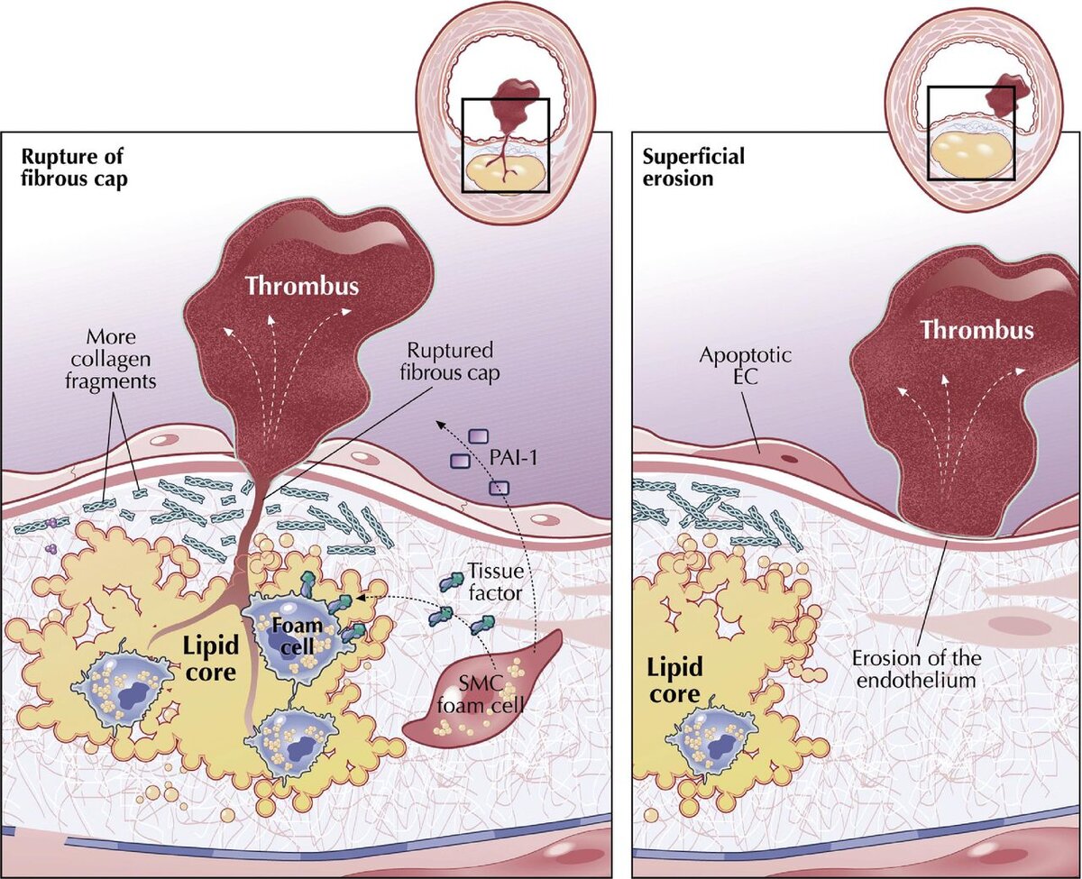 Схема воспалительного атеротромбоза. Являются осложнением атеросклероза.