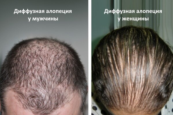 Андрогенное выпадение волос