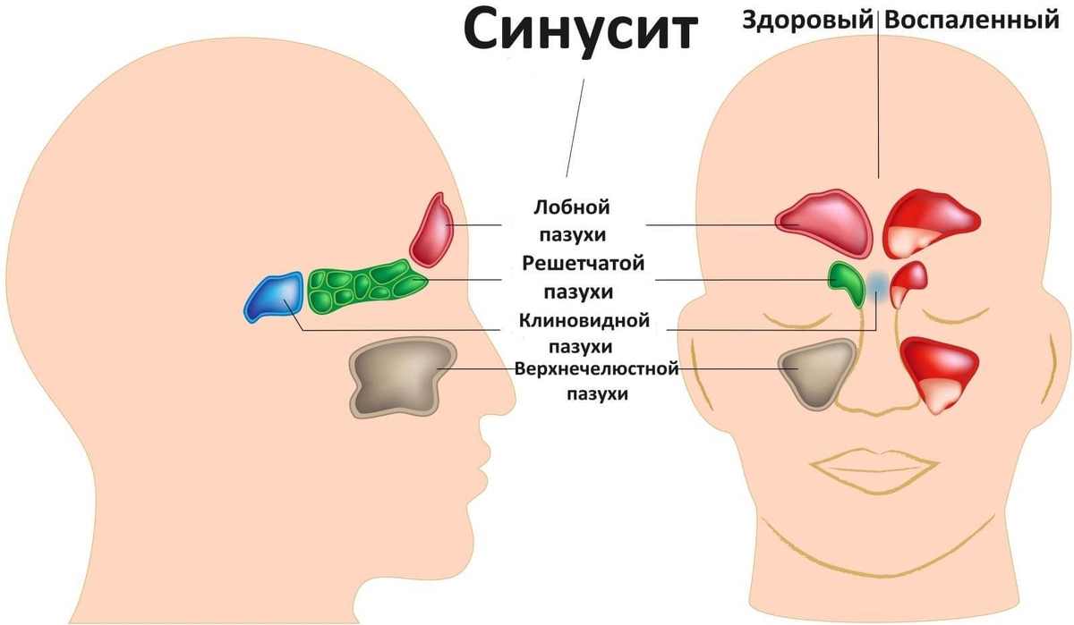 Причины гайморита. Синусит – воспаление придаточных пазух нос. Этмоидит сфеноидит фронтит. Гайморит фронтит этмоидит сфеноидит. Острый сфеноидальный синусит