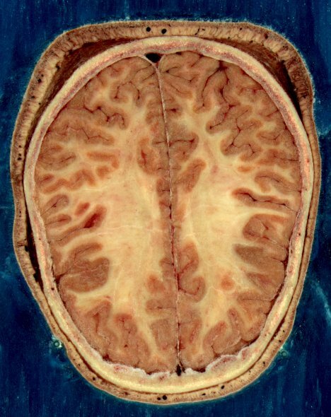 This image was created by a US government project in the National Library of Medicine, a branch of NIH. As government work, it is in the public domain. The original image was modified by user:Looie496 - http://erie.nlm.nih.gov/~dave/vh/avf1067a.png. Общественное достояние