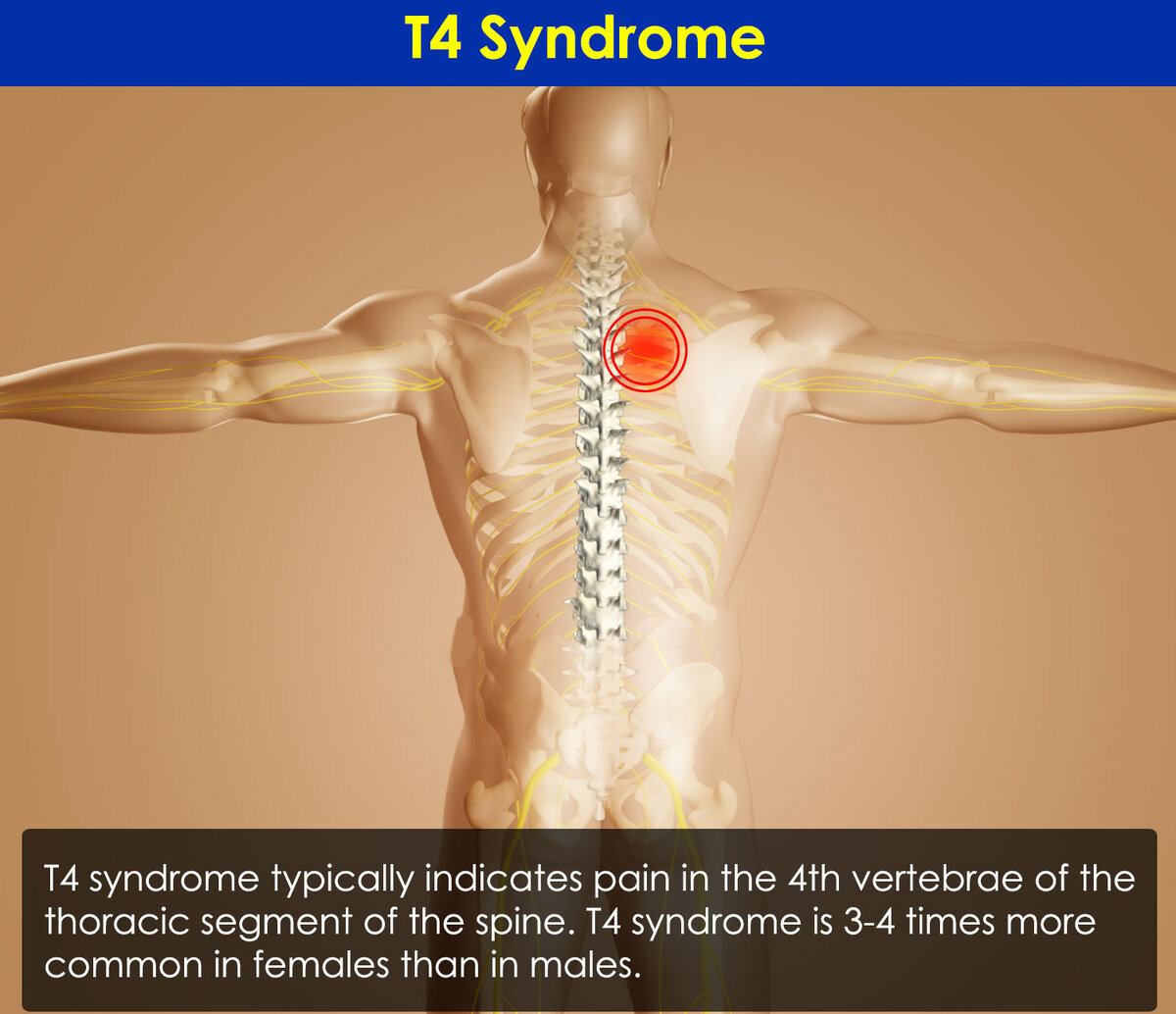 Cиндром обычно указывает на боль в 4-м позвонке грудного сегмента позвоночника