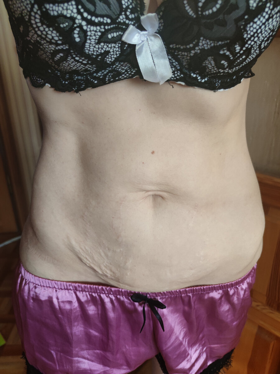 кожа выглядит не на фото эстетичней, и растяжки не так заметны. да и на фото, все равно, я очень довольна такими результатами, и надеюсь, что будет значительно лучше! 