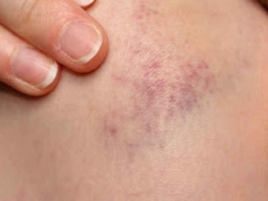 Как проявляется лейкоз (лейкемия, белокровие, рак крови) на ранних ...