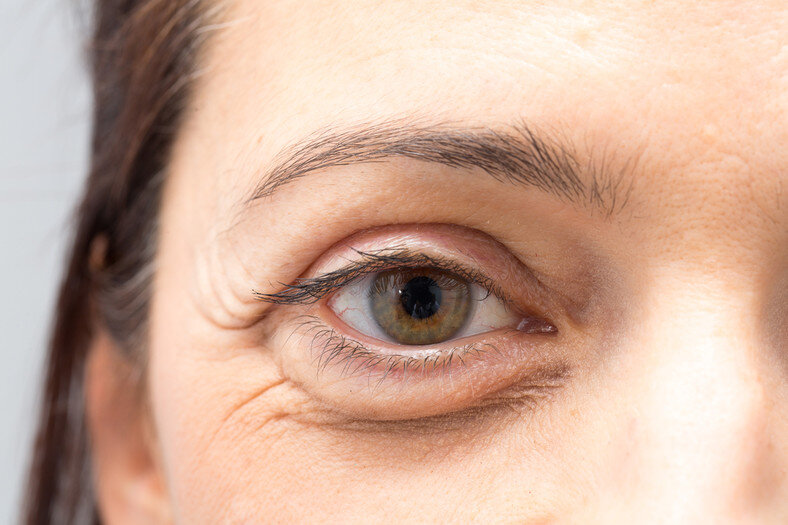 Мешки (отеки) под глазами