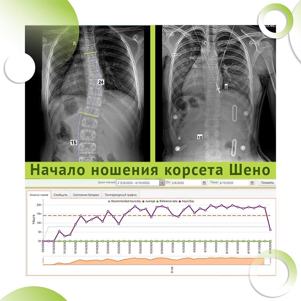 Корсет функционально-корригирующий Шено