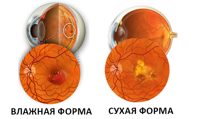 Возрастная макулярная дегенерация презентация