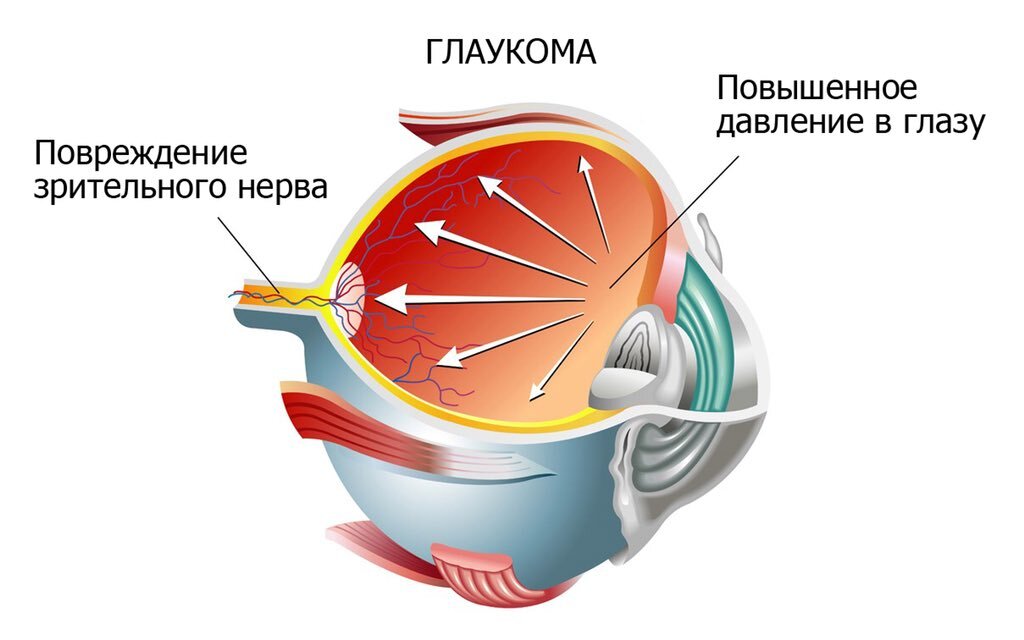 Глазное давление при глаукоме. Внутриглазное давление. Повышенное внутриглазное давление. Регуляция внутриглазного давления. Повышение внутриглазного давления.