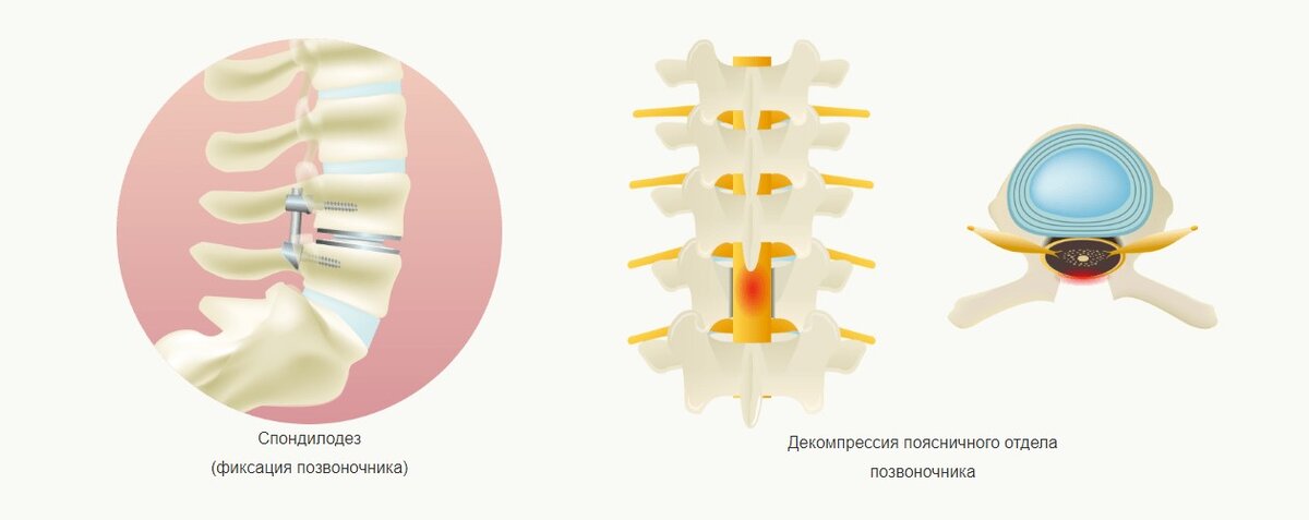 Хирургическое лечение спондилолистеза