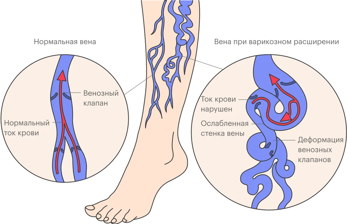 Здоровье вен нижних конечностей. Варикозное расширение вен. Варикозное расширение вен нижних конечностей. Варикозная болезнь нижних конечностей.