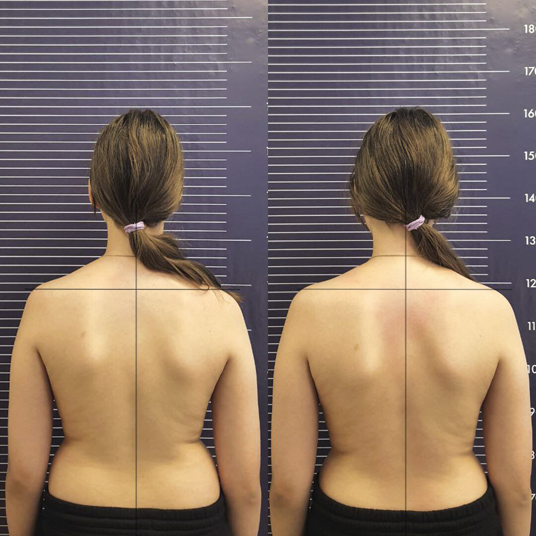 До/после пациентов После процедуры Реконструкции тела врачей остеопатов Клиники Реконструкции Тела в Москве