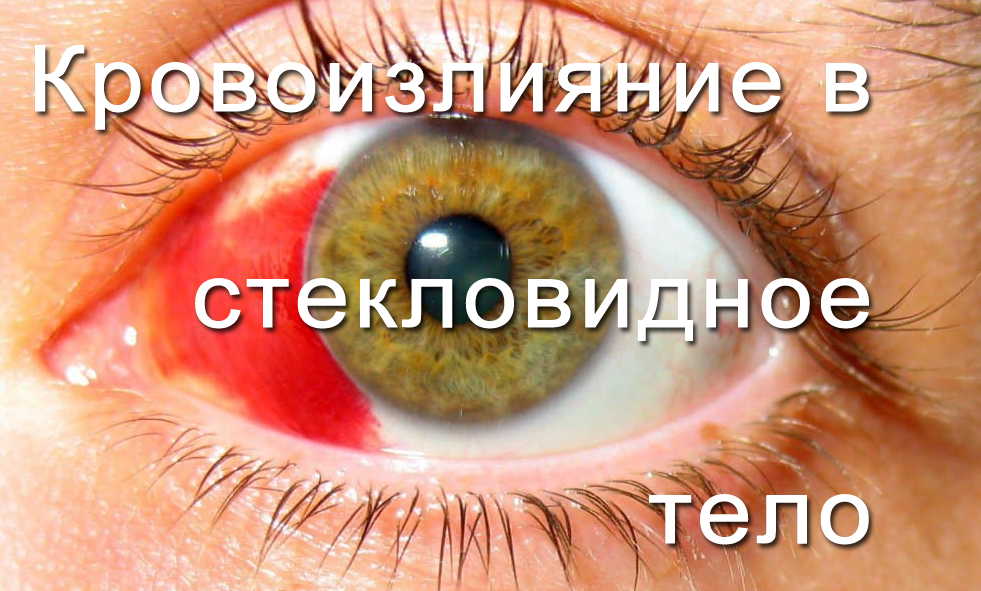Кровоизлияние в стекловидное тело
