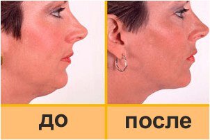 Бмс лица до и после