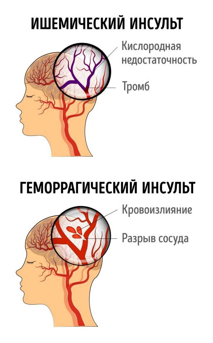 Виды инсульта