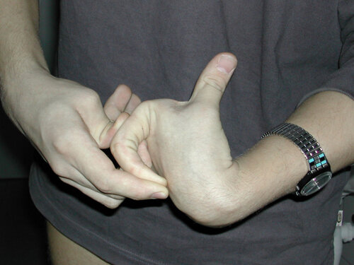 Патологическая гибкость костей.