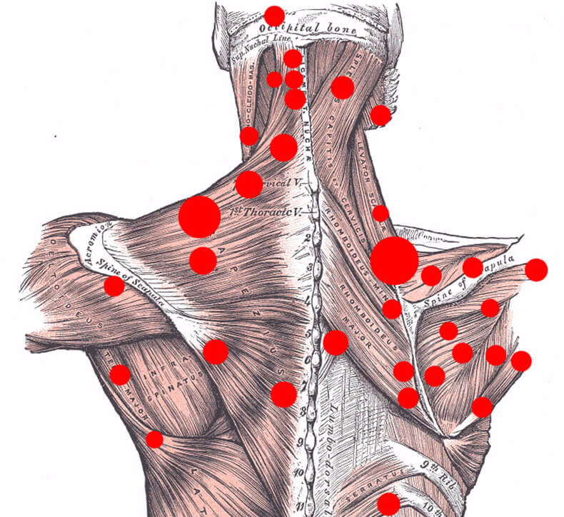 "карта" расположения триггеров в грудном и шейном отделах