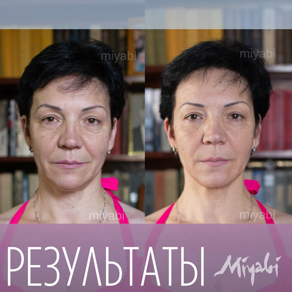 Результат участницы одного из моих марафонов впечатляет! Посмотрите, как поднялись брови, раскрылся взгляд, разгладился лоб. И всё это без уколов, подтяжек, аппаратов. Только руки и знания.