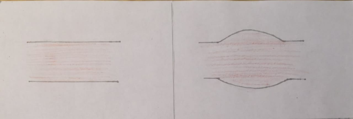 Норма/Вялый тонус