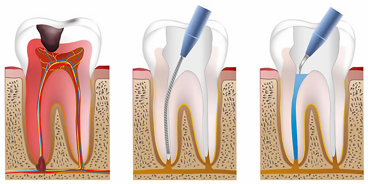 Удаление нерва зуба