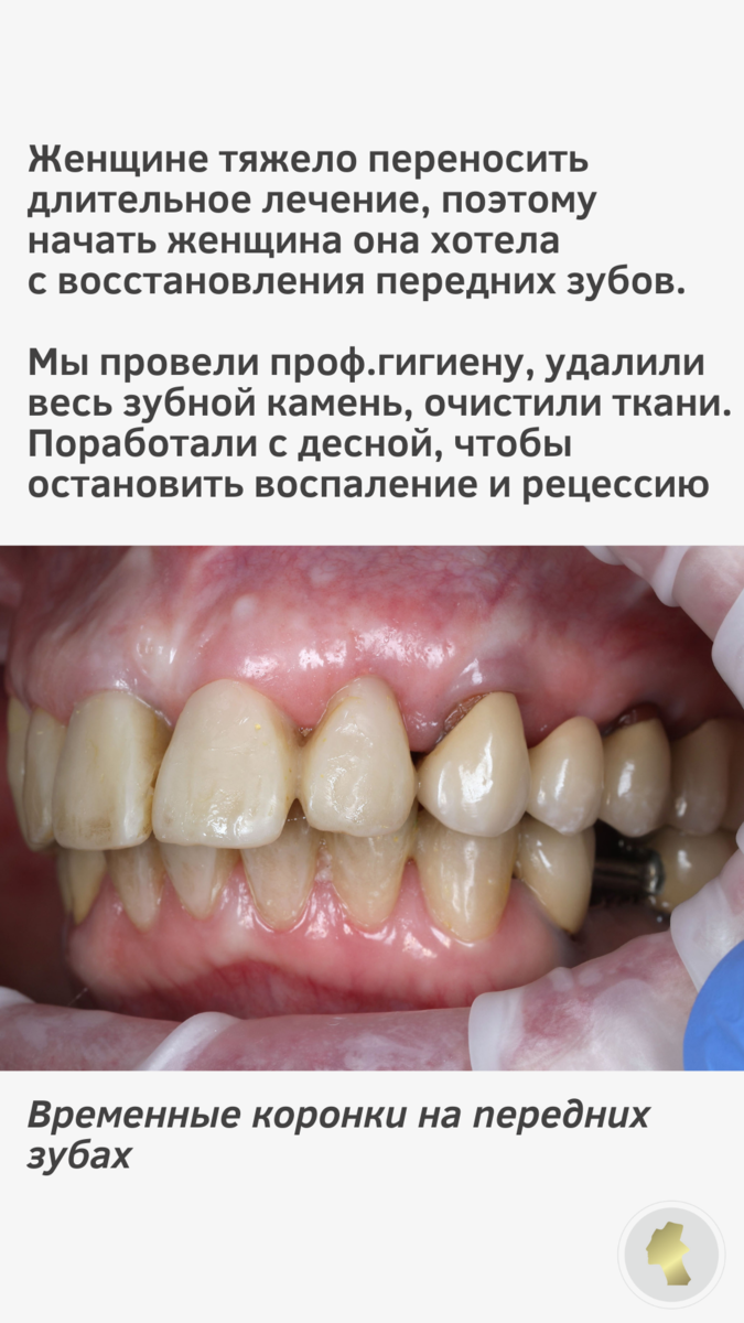 Парадонтит | Спасибо.Клиник | Дзен