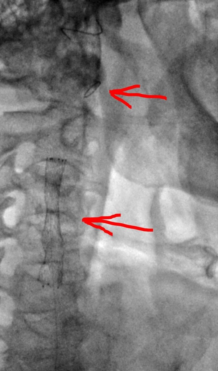 Carotid artery atherosclerosis