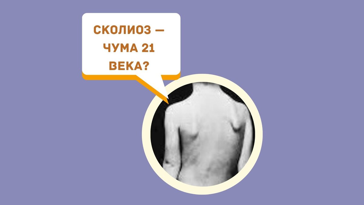 Сколиоз — чума 21 века?