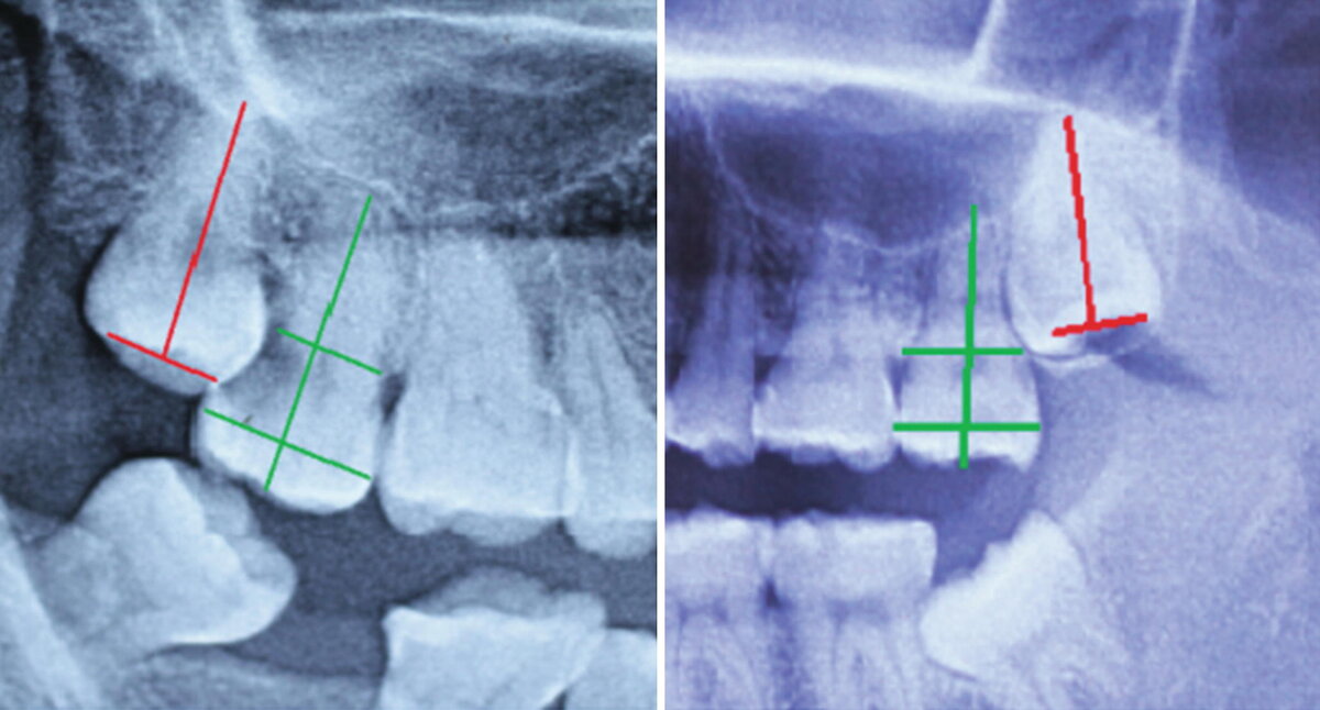 Можно ли при удаление. Искривление из-за зуба мудрости. Зуб мудрости под углом. После удаления зуба мудрости. Апексфиксация зуба мудрости.