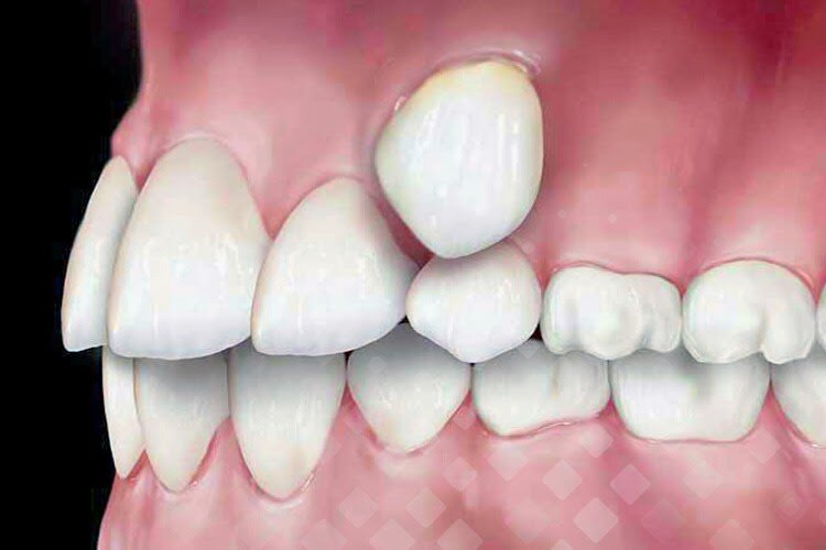 Дистопия часто встречается у детей во время смены молочных зубов на постоянные, когда зубам, прорезывающимся позже остальных, просто не хватает места в зубном ряду. Фото: Яндекс.Картинки.