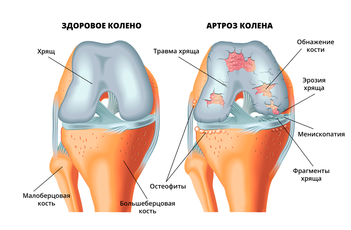 Что делать, если артроз прогрессирует? | Клиника «Тибет» | Дзен