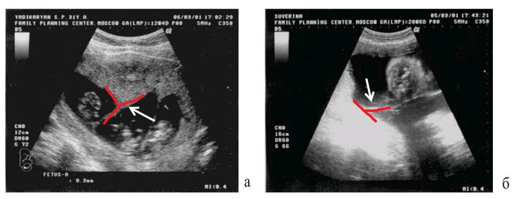 Двойняшки монохориальная диамниотическая. Выделение при двойни. Выделение при двойни. Формирование плодных оболочек и плаценты при двойне:. Узи многоплодной беременности 12 недель.
