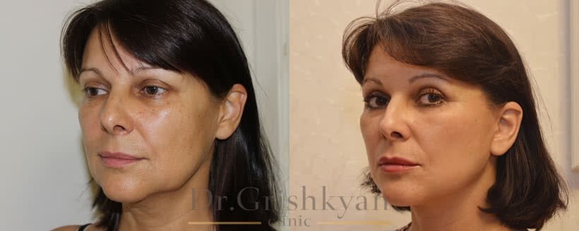 Круговая подтяжка лица фото до и после. Фото с сайта Д.Р. Гришкяна. Имеются противопоказания, требуется консультация специалиста