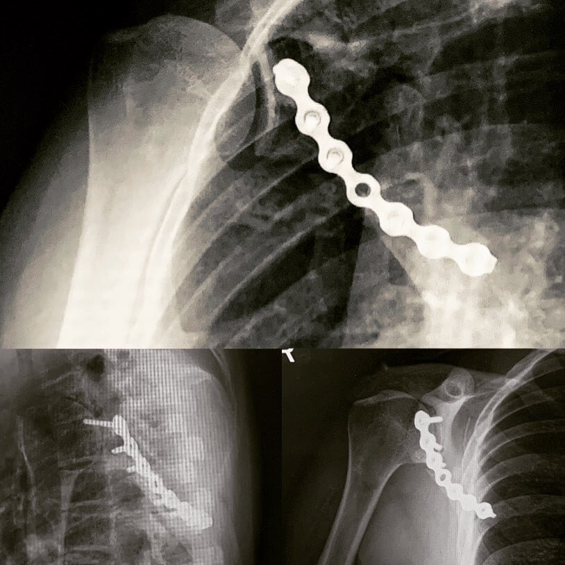 Перелом акромиона лопатки рентген. Перелом шейки лопатки рентген. Перелом лопатки рентген. Перелом лопатки снимок.