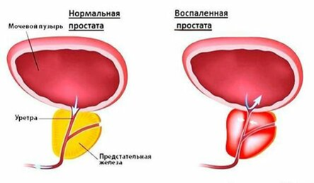 Рак предстательной железы