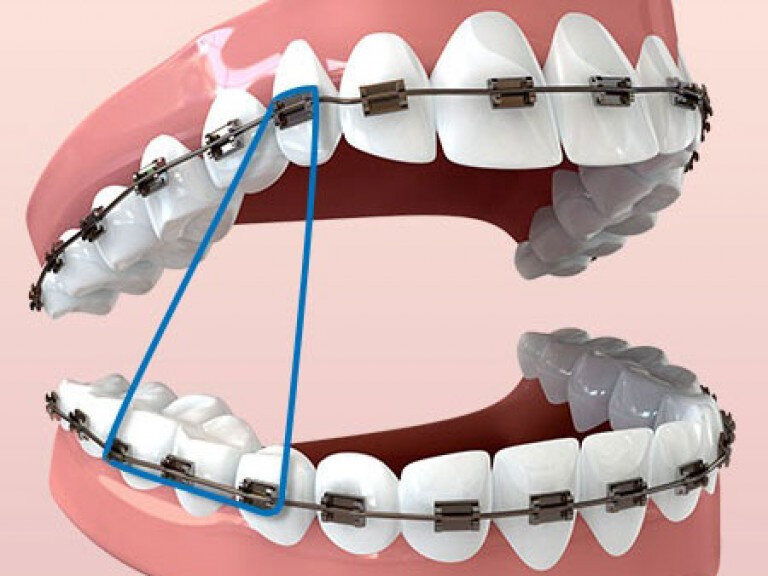 Схемы ношения эластиков при брекетах