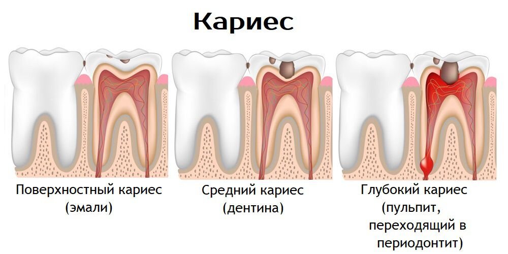 Стадии кариеса картинки
