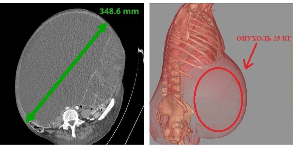     Образование занимало все пространство живота. Фото: ЛОКБ