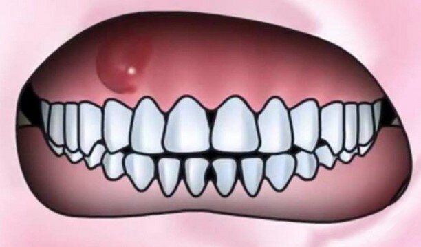 «Появилась шишка на десне. Что это может быть?» | Стоматология ROOTT | Дзен