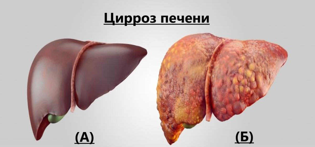 (А) - здоровая печень, (Б) - печень пораженная циррозом