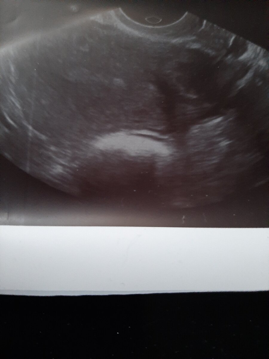 Интрамуральная миома с характерной акустической тенью. Выглядит, как " комета с хвостом".Самая что ни на есть " миомистая миома")) Фото из личного архива автора.