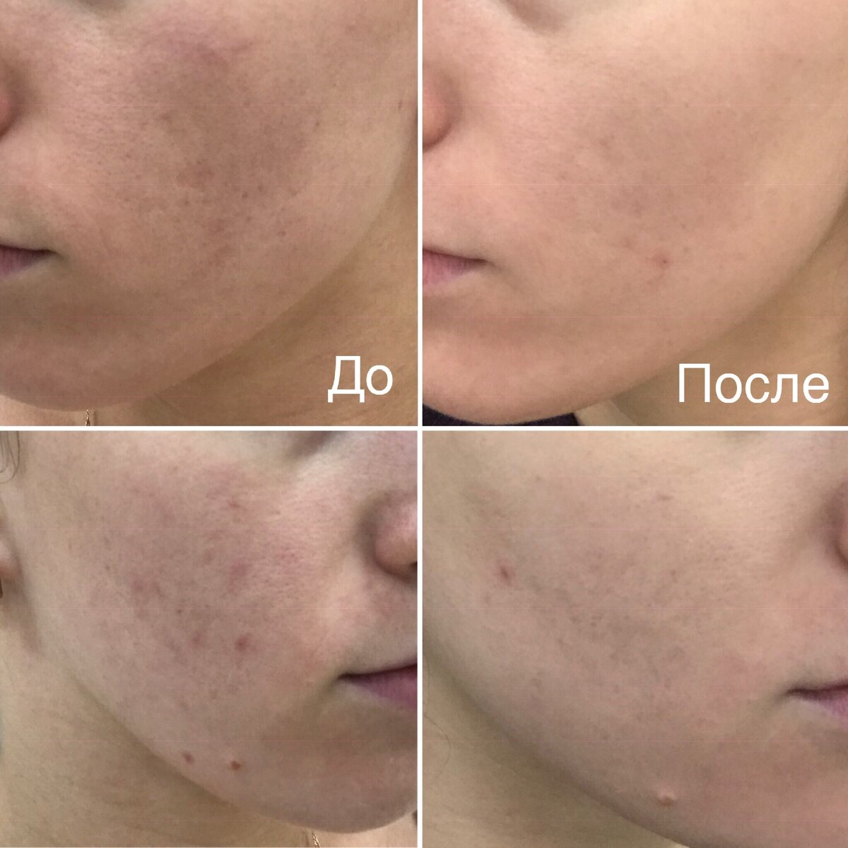 «Эффект тонального» через месяц после первой процедуры. 