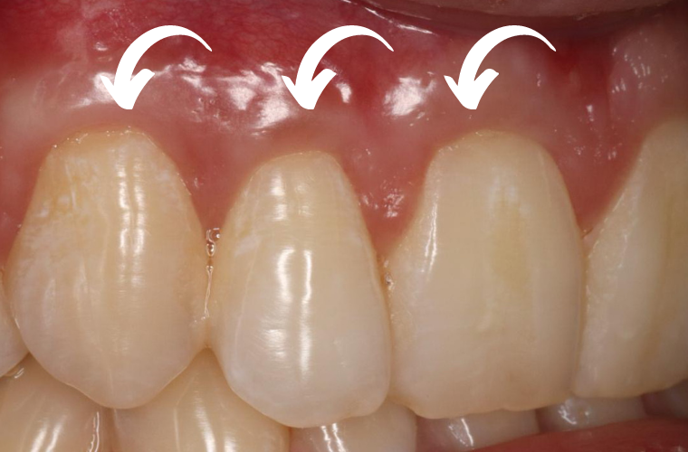 А так выглядит десна спустя время после гингивопластики