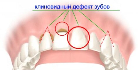 Так выглядит клиновидный дефект на зубах. Изображение из свободных источников.